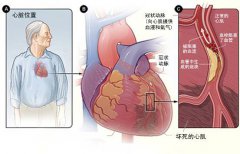 冠心病的起因是什么？