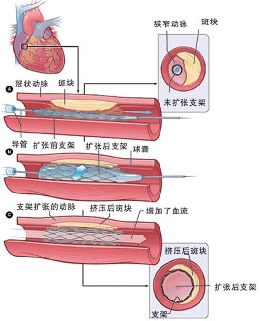 怎樣治療冠心??？(圖2)