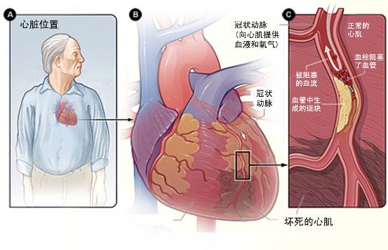 怎樣治療冠心??？(圖3)